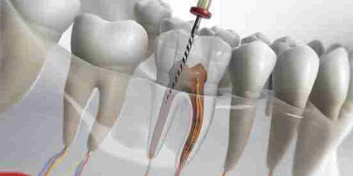 Preserving Your Smile: Advanced Root Canal and Gum Treatments in Arlington