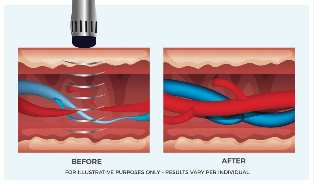 Erectile Dysfunction Treatment - ED Treatment Kitchener, Ottawa - FocusWave Clinic