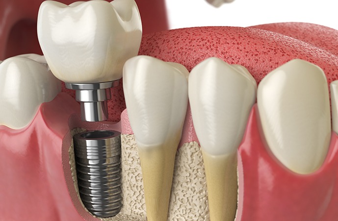 Take Care of Your Dental Implants: Know How?