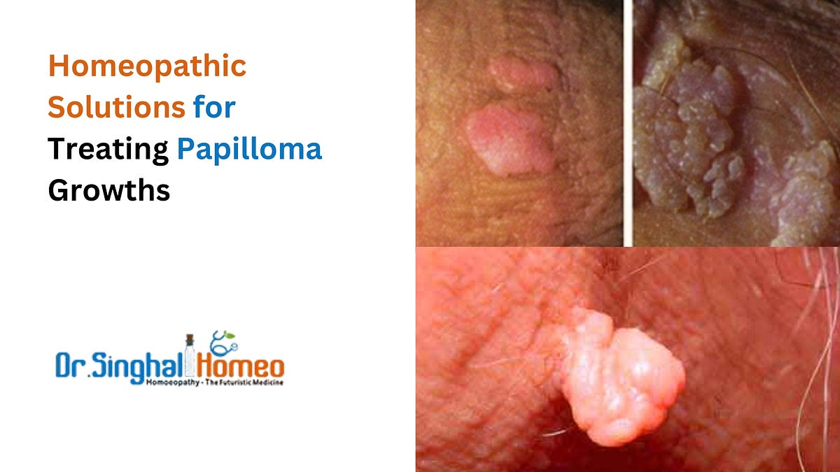 Natural Healing: A Guide to Homeopathic Treatments for Papilloma | by Dr. Singhal Homeo | Nov, 2024 | Medium