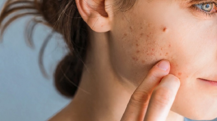 Top 5 Home Remedies for Pimples 2024