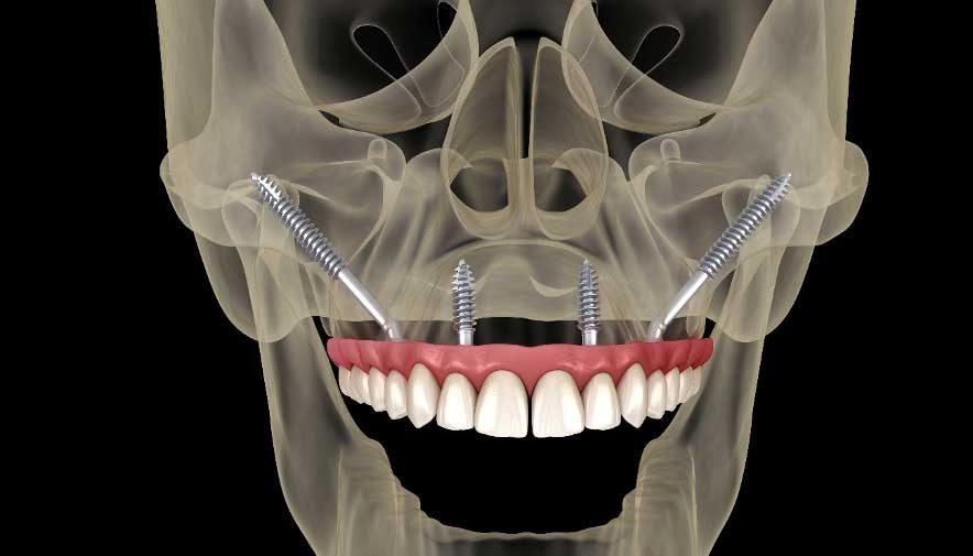 implantes cigomáticos precios