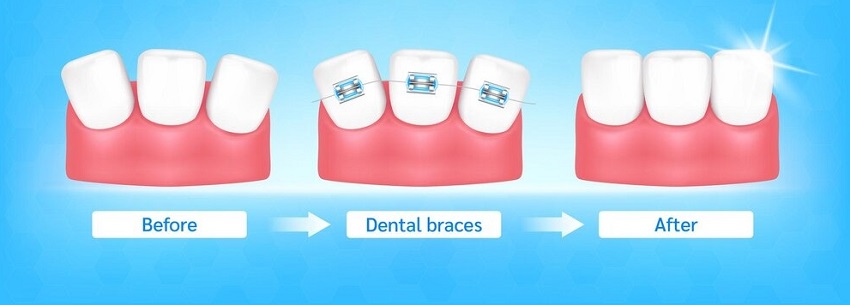 Why Modern Orthodontics Are a Better Choice for Patients? – Dentists of Preston