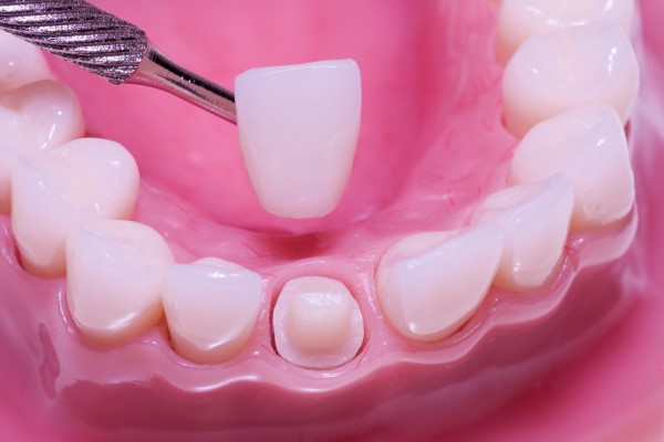 Step-by-Step Guide to the Dental Crown Procedure – Telegraph