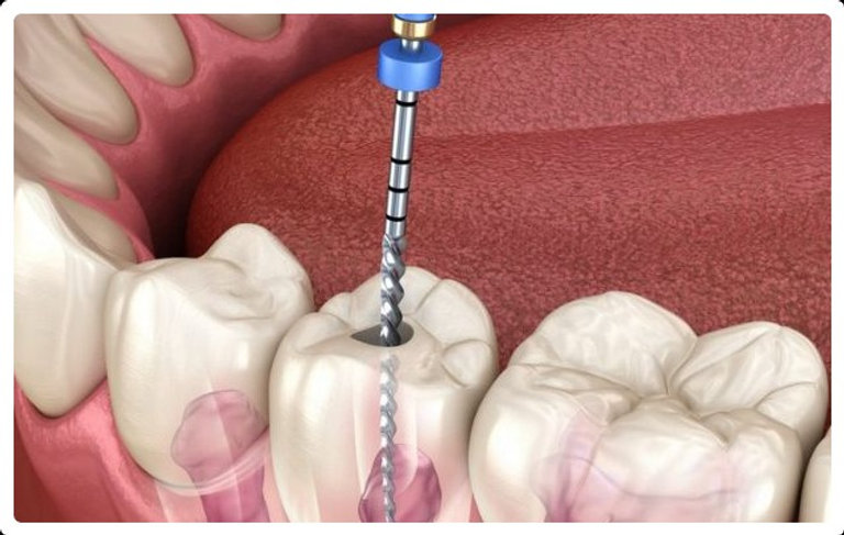 What to Expect During a Root Canal Procedure in Melbourne