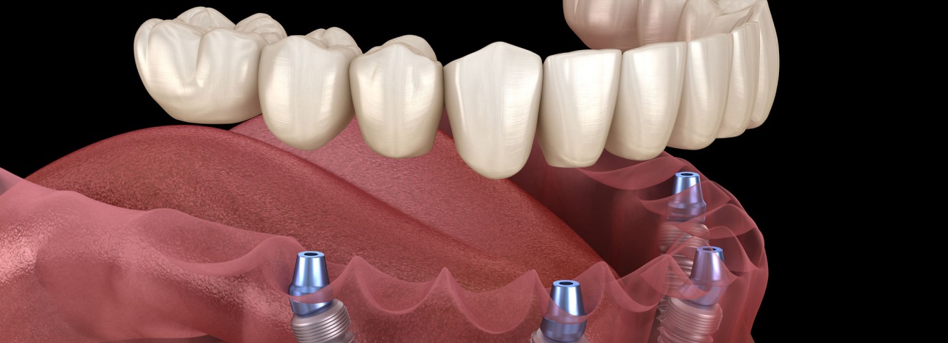 Best Dental Implants in Melbourne A Solution for Missing Teeth